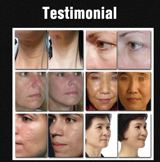 2024 professional face lifting wrinkle removal machine skin tightening machine pe-face em face lifting machine - Sun Studio