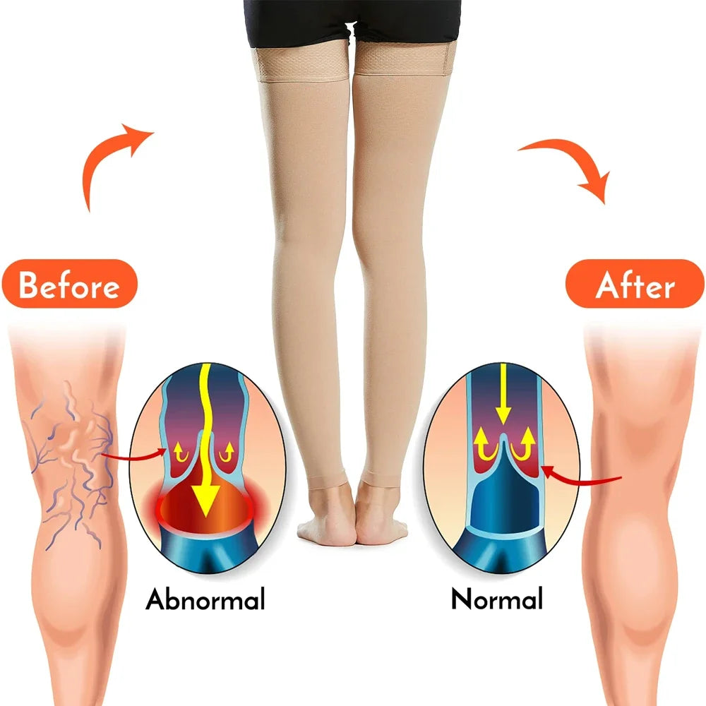 Medical Open Toe Thigh High Compression Stockings with Silicone for Women Men,20-30 mmHg Graduated Support for Varicose Veins - Sun Studio